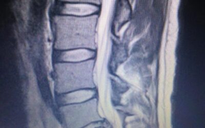 Evidence-Based Chiropractic For Lower Back Pain: What To Expect In Your First 3 Visits